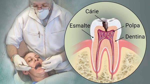 carie dentaria carie dentaria